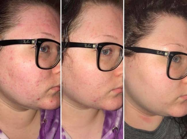 reviewer's cheek with painful looking breakouts, then with the same cheek healing up, then the same cheek completely clear 