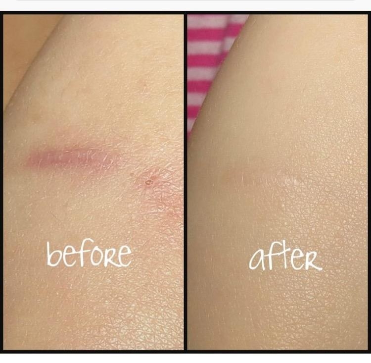 A before photo of a reviewer&#x27;s scar, which is red and a little raised, and an after photo of the same reviewer&#x27;s scar, which is now the same color as their skin and barely noticeable