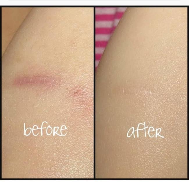 A before photo of a reviewer's scar, which is red and a little raised, and an after photo of the same reviewer's scar, which is now the same color as their skin and barely noticeable