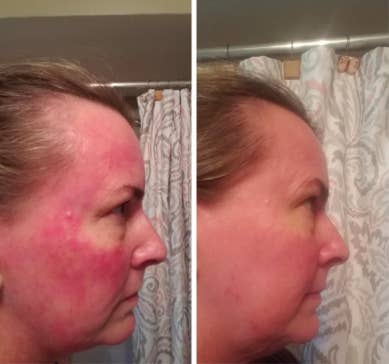reviewer pic of very blotchy painful looking rosacea all over the face, then an after pic of the red irritation looking much lighter