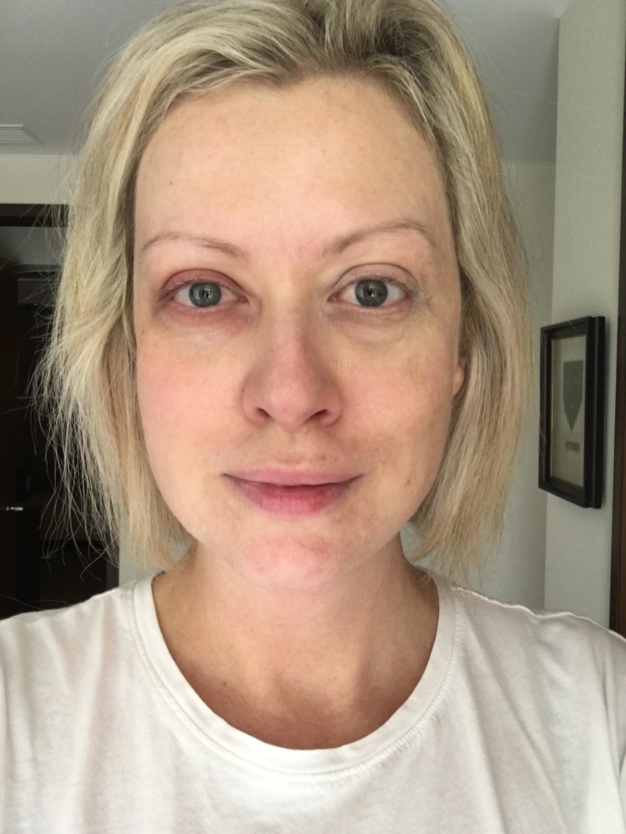 A reviewer who&#x27;s used the makeup under one eye, but not the other; the undereye with the makeup on blends in with her cheek skin tone; the one without makeup looks a little grey-purplish