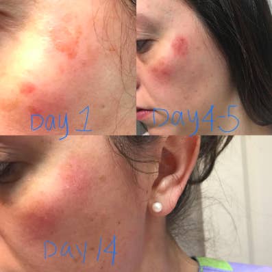 reviewer pic of bright red patch on cheek, then it's a little darker on day 4, then it's lightened up significantly and healing on day 14