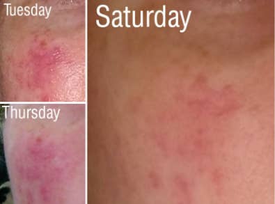 reviewer's pic of a very bright looking patch of rosacea breakout, then it lightened two days after initial treatment, then much later four days later