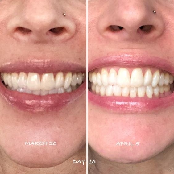 effective teeth whitening toothpaste