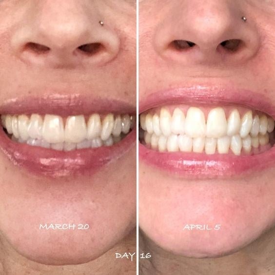 Reviewer photo showing results of using White Birch whitening toothpaste