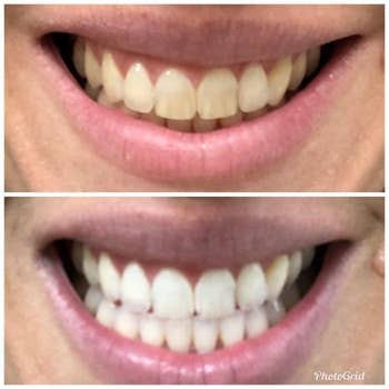 Reviewer's before and after picture with yellowed teeth and then whiter teeth 