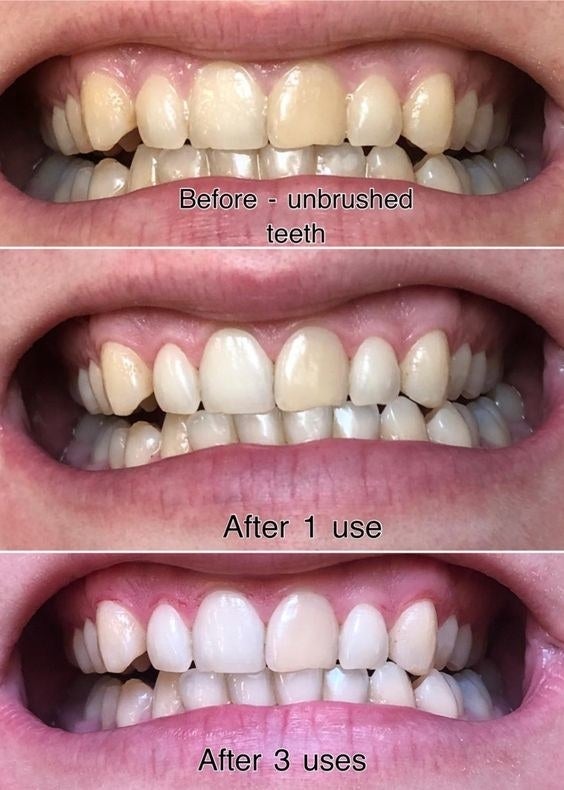 Reviewer&#x27;s before-and-after picture to show dramatic whitening after three uses