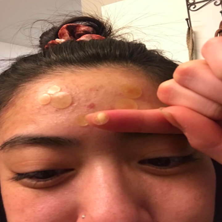 A reviewer with several of the small round patches on their forehead, holding one up to show how much goop it absorbed