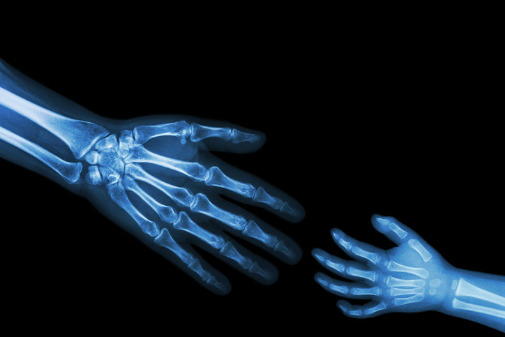 X-ray of a child&#x27;s and an adult&#x27;s hand