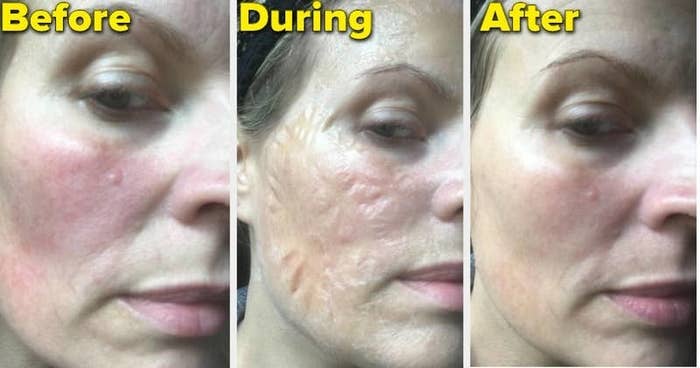 a reviewer showing a before, during, and after photo using the zombie face mask and how it reduced redness 