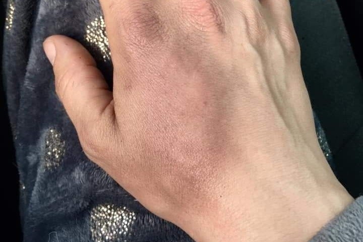 A right hand showing significant bruising 