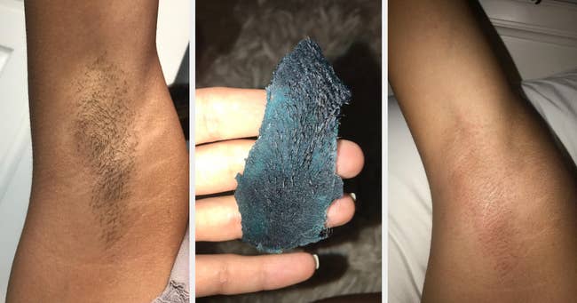 A before image of a reviewer's underarm hair, then the blue wax with hair of it, and an after image of the reviewer's hairless underarms 