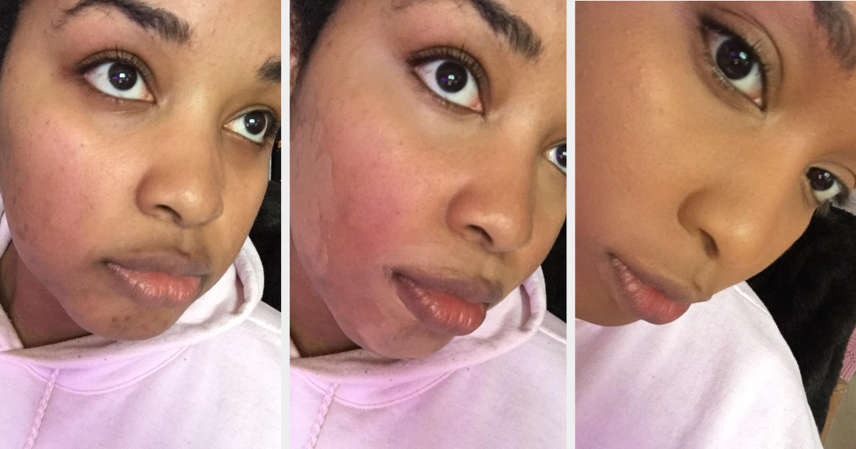 Reviewer with before, during, and after shots of coverage from the concealer 