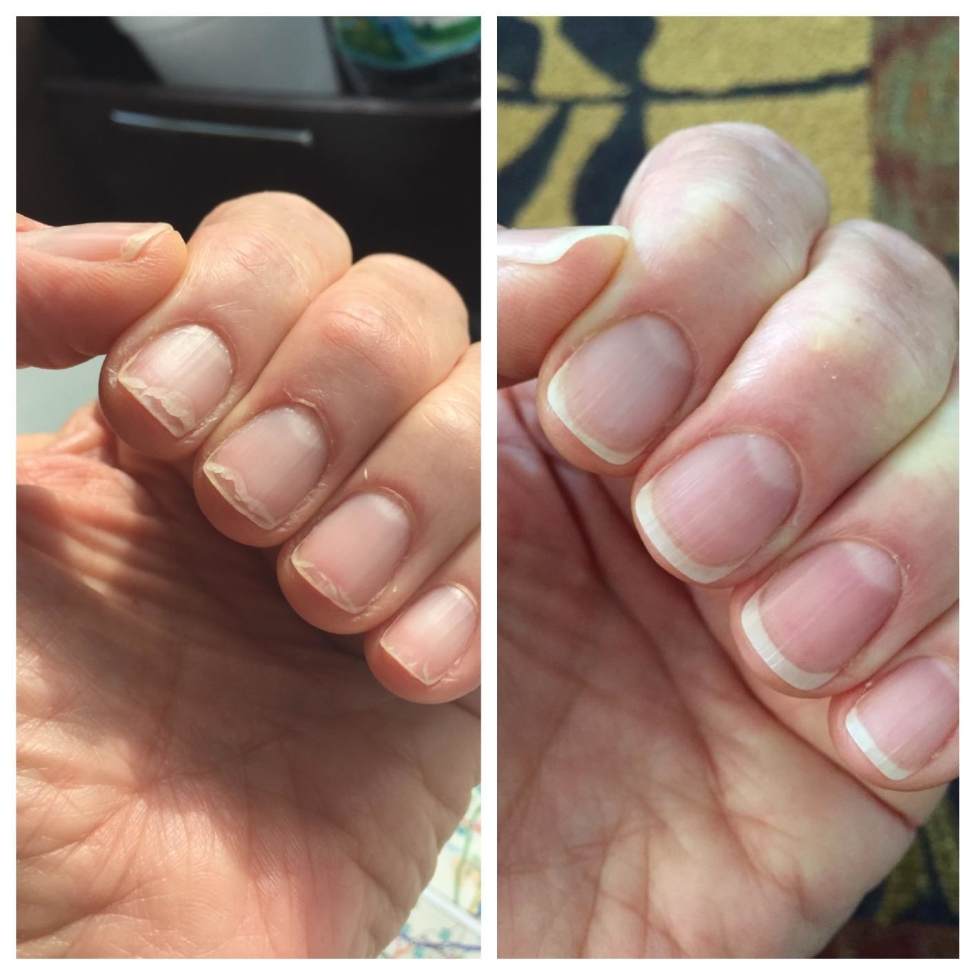 A sooner than image of a reviewer's brittle nails and an after image of them mighty heaithier