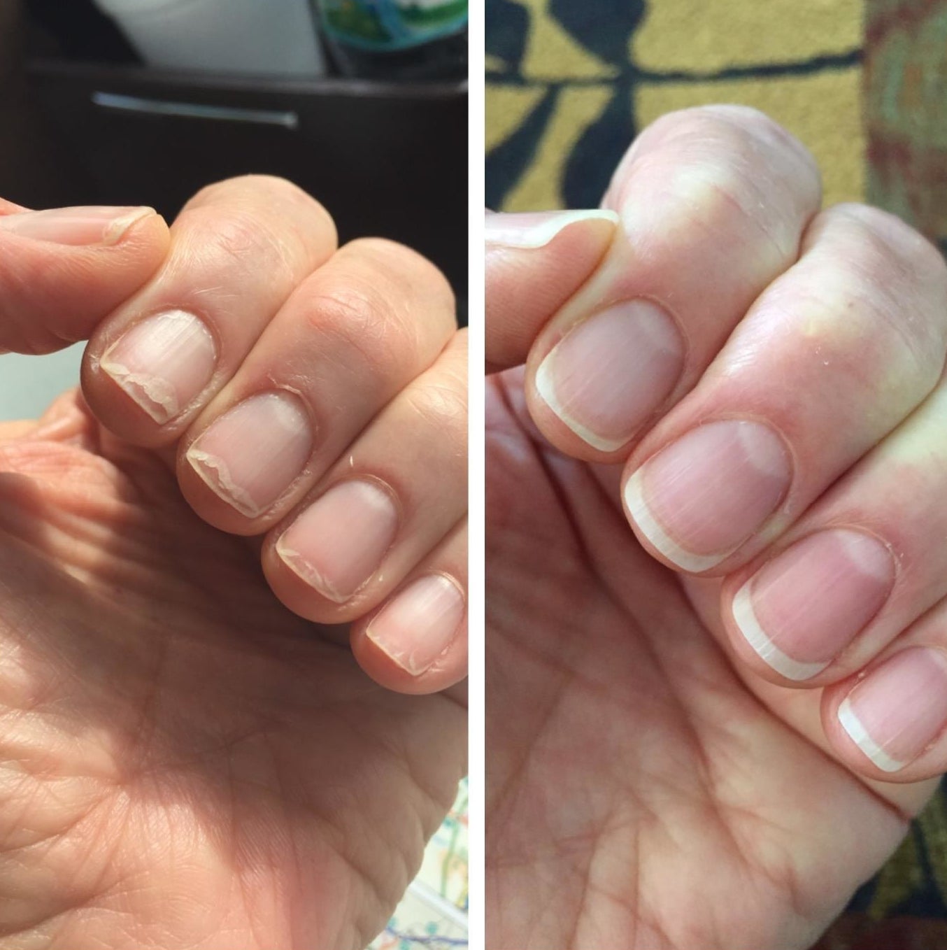 A before image of a reviewer&#x27;s brittle nails and an after image of them much heaithier