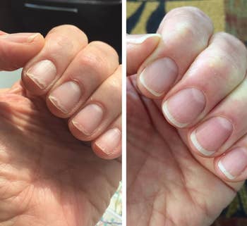 A before image of a reviewer's brittle nails and an after image of them much heaithier
