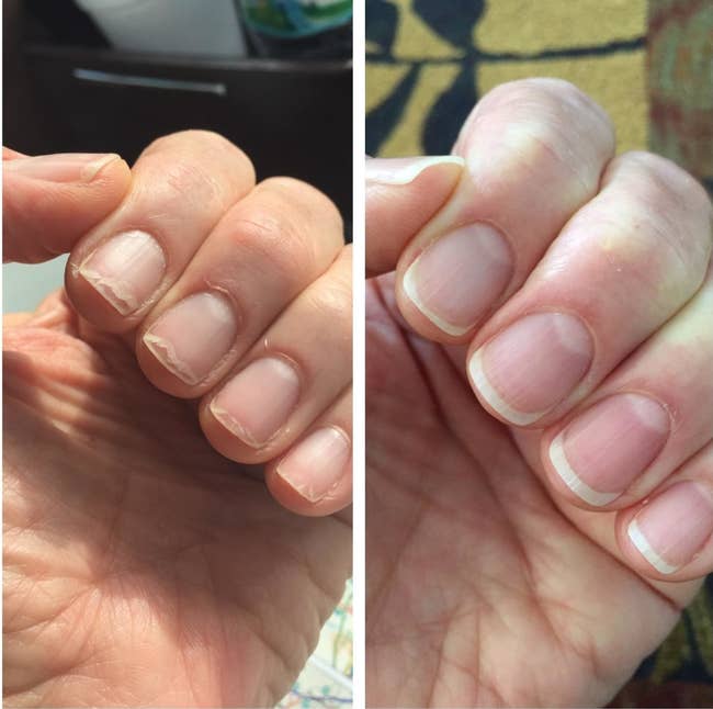 A before of a reviewer's brittle nails and an after of them much healthier and less cracked