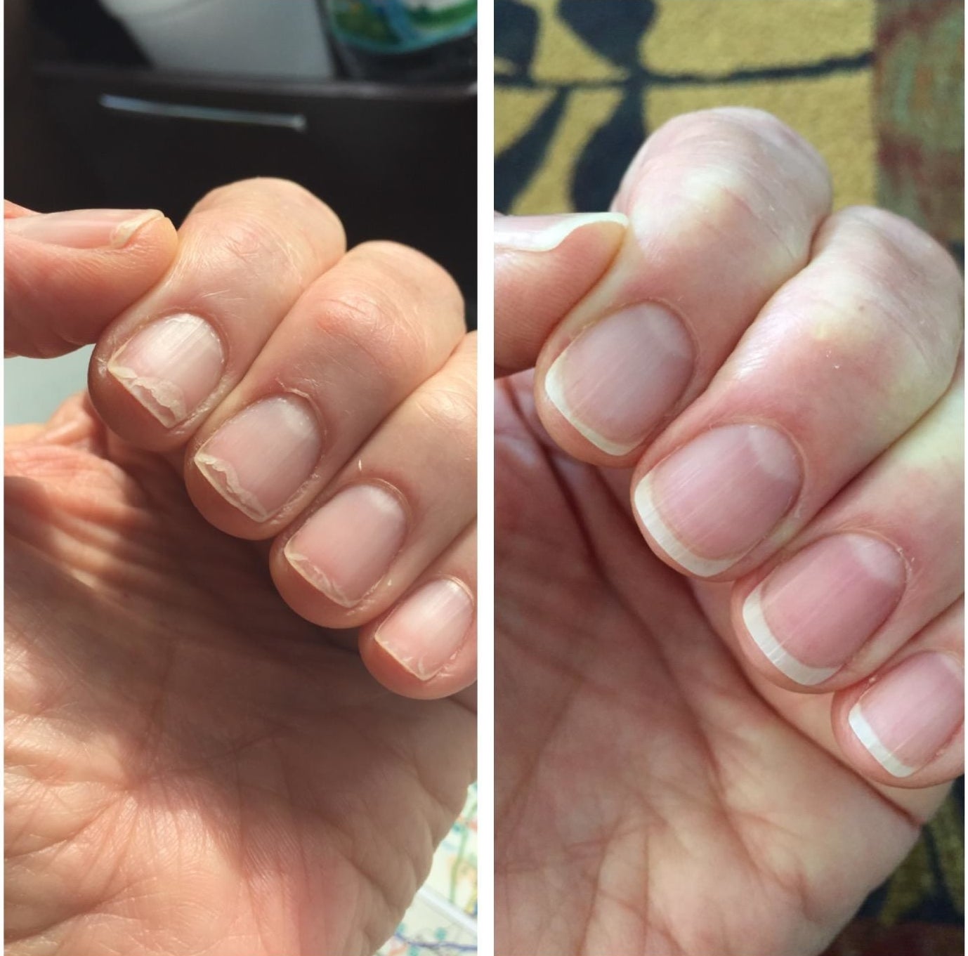 A before image of a reviewer's brittle nails and an after image of them much heaithier
