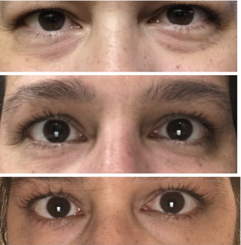 Reviewers before and after pictures of their under eye area becoming smoother 