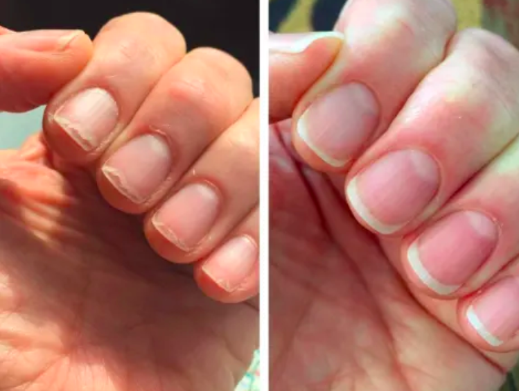 a before and after photo set displaying a reviewer&#x27;s nail growth after using the solaroil