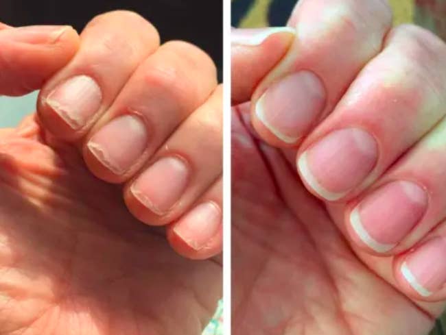 a before and after photo set displaying a reviewer's nail growth after using the solaroil