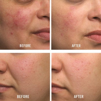 Reviewers with blemished, inflamed skin before using the product / Reviewers with less red skin after using the cream