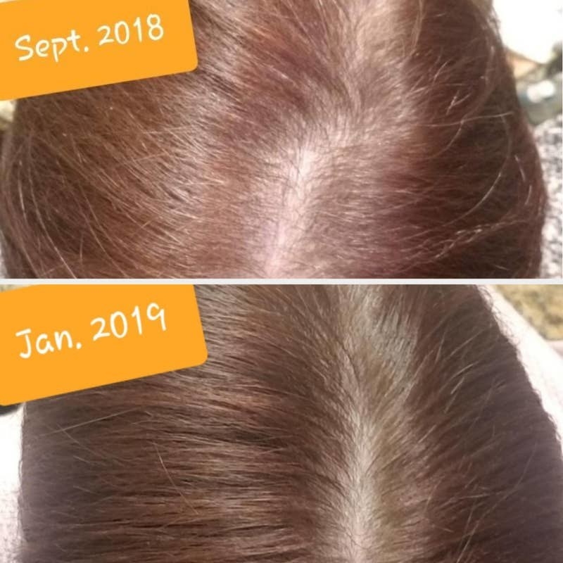 a before and after photo showing a reviewer&#x27;s hair looking thicket after four months of use of the shampoo
