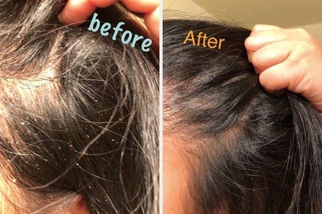 reviewer before and after showing dandruff in their hair decreasing after using the shampoo
