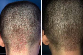 a before and after photo of a reviewer's scalp looking less red and irritated after using the shampoo brush