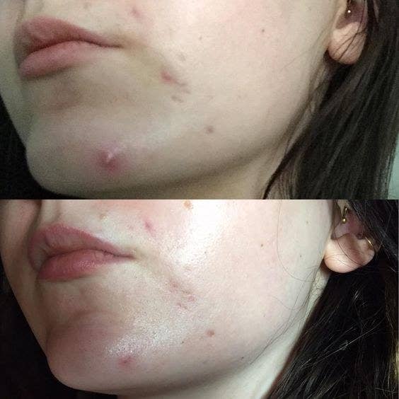A split before and after image showing a reviewer&#x27;s chin with cystic acne and the same reviewer with the look of the acne diminished 