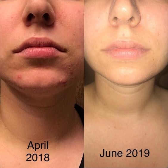A split reviewer image showing a swollen chin with cystic acne and text reading "April 2018" and the same chin cleared of acne with text reading "June 2019"
