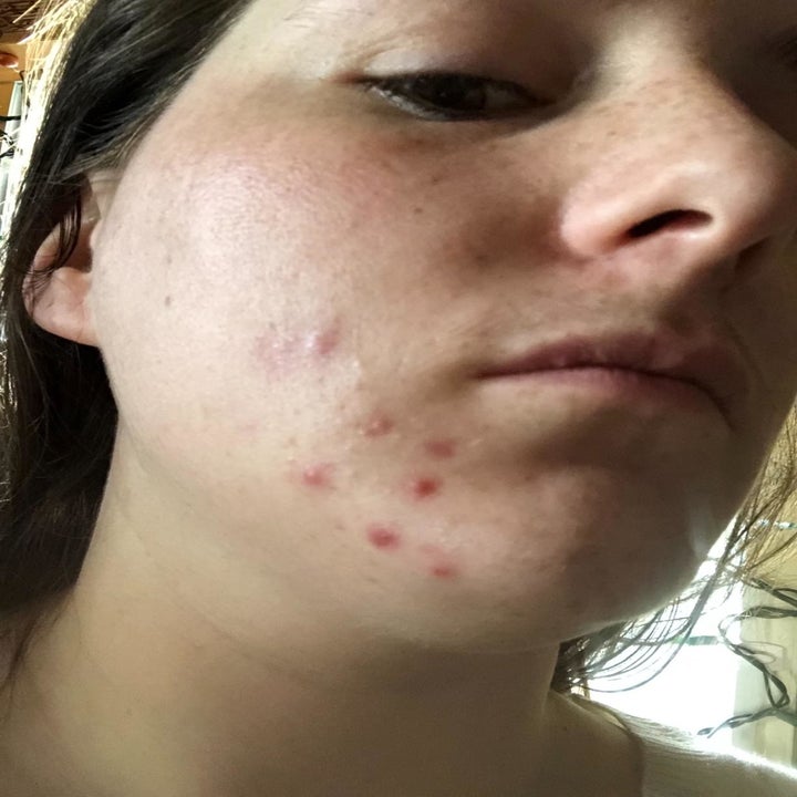A "before" image of a reviewer with spots of cystic acne on their chin 