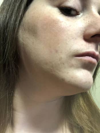 Same reviewer with the redness of the acne gone and marks almost invisible 