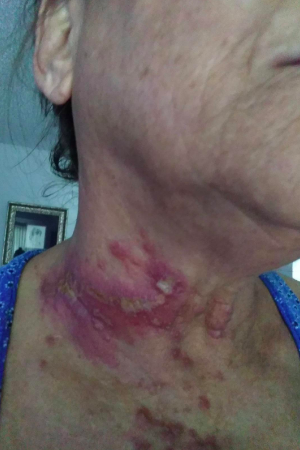 Reviewer with very dark, almost purple red rash on neck with what looks to be puss-filled buildup in certain areas 