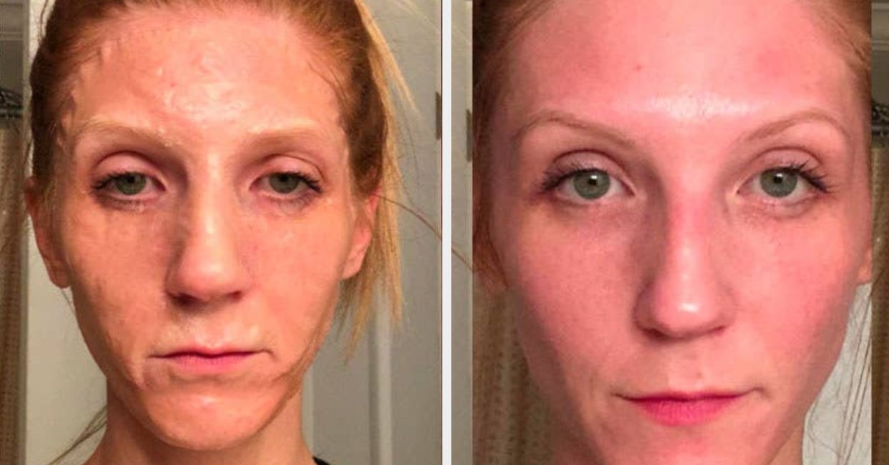 hoe Recyclen serie 8 Face Masks With Before-And-After Photos That Might Make You A Believer