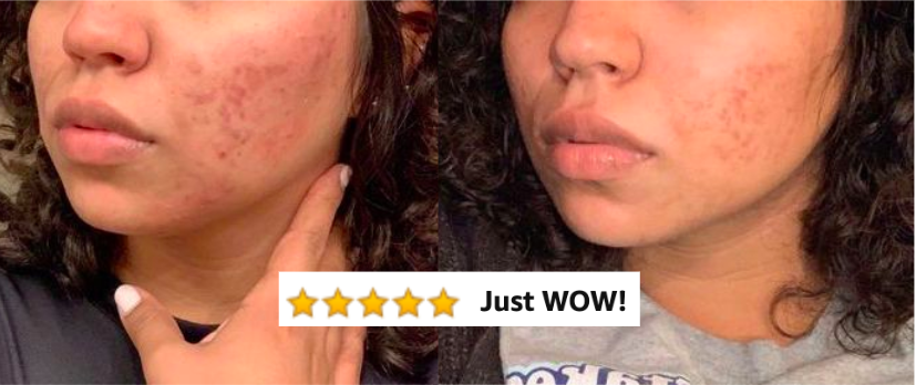 Reviewer&#x27;s before picture with acne scarring on her cheeks, and after picture with very faded scarring. There&#x27;s a five-star Amazon caption on top that says, &quot;Just wow.&quot; 