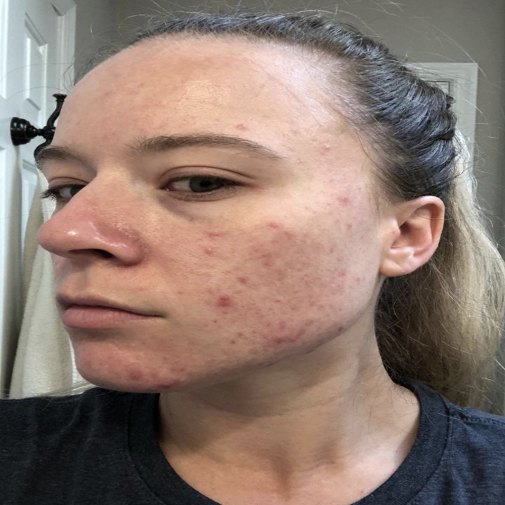 Reviewer showing facial acne