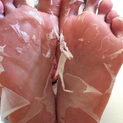 Results of using Baby Foot peel