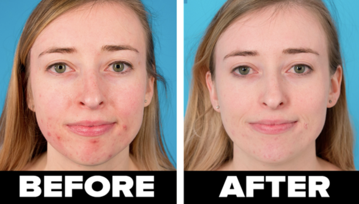 On the left, BuzzFeed editor Sarah Wainschel&#x27;s face before using the clay mask. On the right, Wainschel&#x27;s face with less acne after using the clay mask