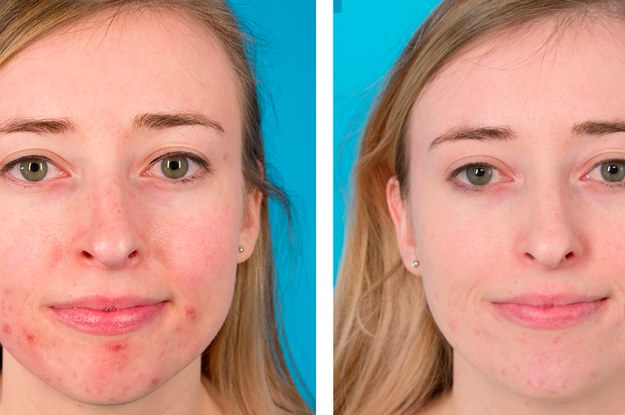 Download 10 Face Masks With Before And After Photos That Will Make You A Believer PSD Mockup Templates