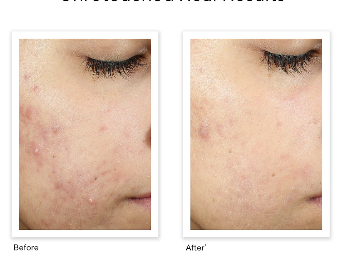 A before and after photo showing how a person&#x27;s face progressed from multiple red post-acne marks to the marks looking almost completely faded