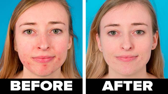 on the left, BuzzFeed employee Sarah Wainschel with redness and acne around her chin labeled &quot;before&quot; and on the right, an image of Sarah labeled &quot;after&quot; with significantly less acne 