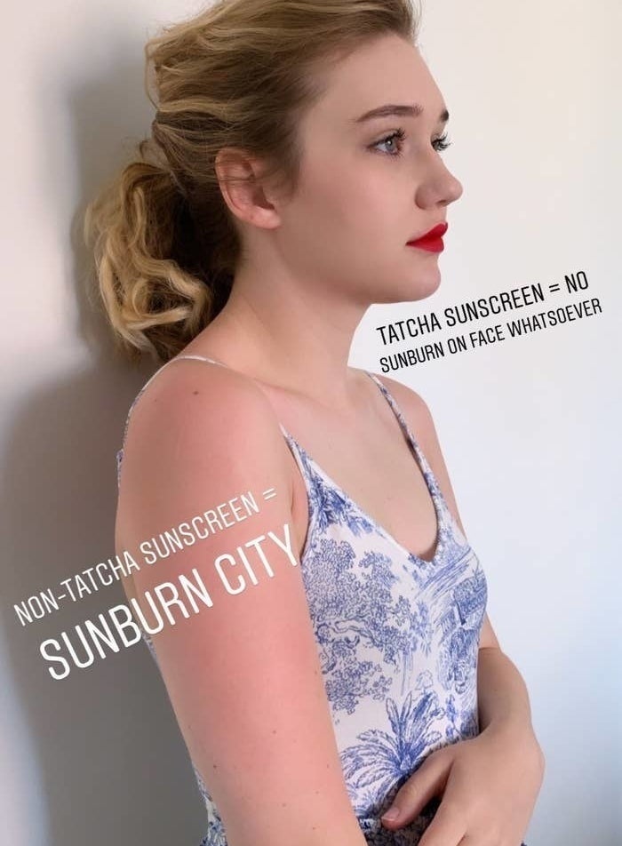 BuzzFeed Senior Editor Maitland Quitmeyer with redness on arm labeled &quot;non-Tatcha sunscreen = sunburn city&quot; and face with no redness labeled &quot;Tatcha sunscreen = no sunburn on face whatsoever&quot; 