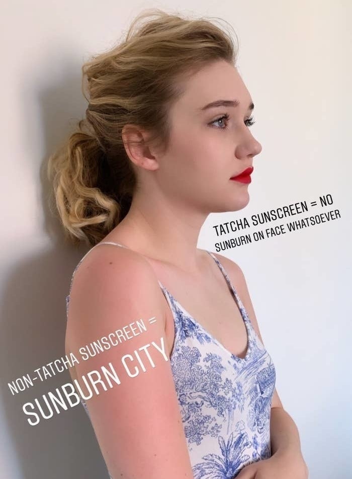 BuzzFeed Senior Editor Maitland Quitmeyer with redness on arm labeled &quot;non-Tatcha sunscreen = sunburn city&quot; and face with no redness labeled &quot;Tatcha sunscreen = no sunburn on face whatsoever&quot; 