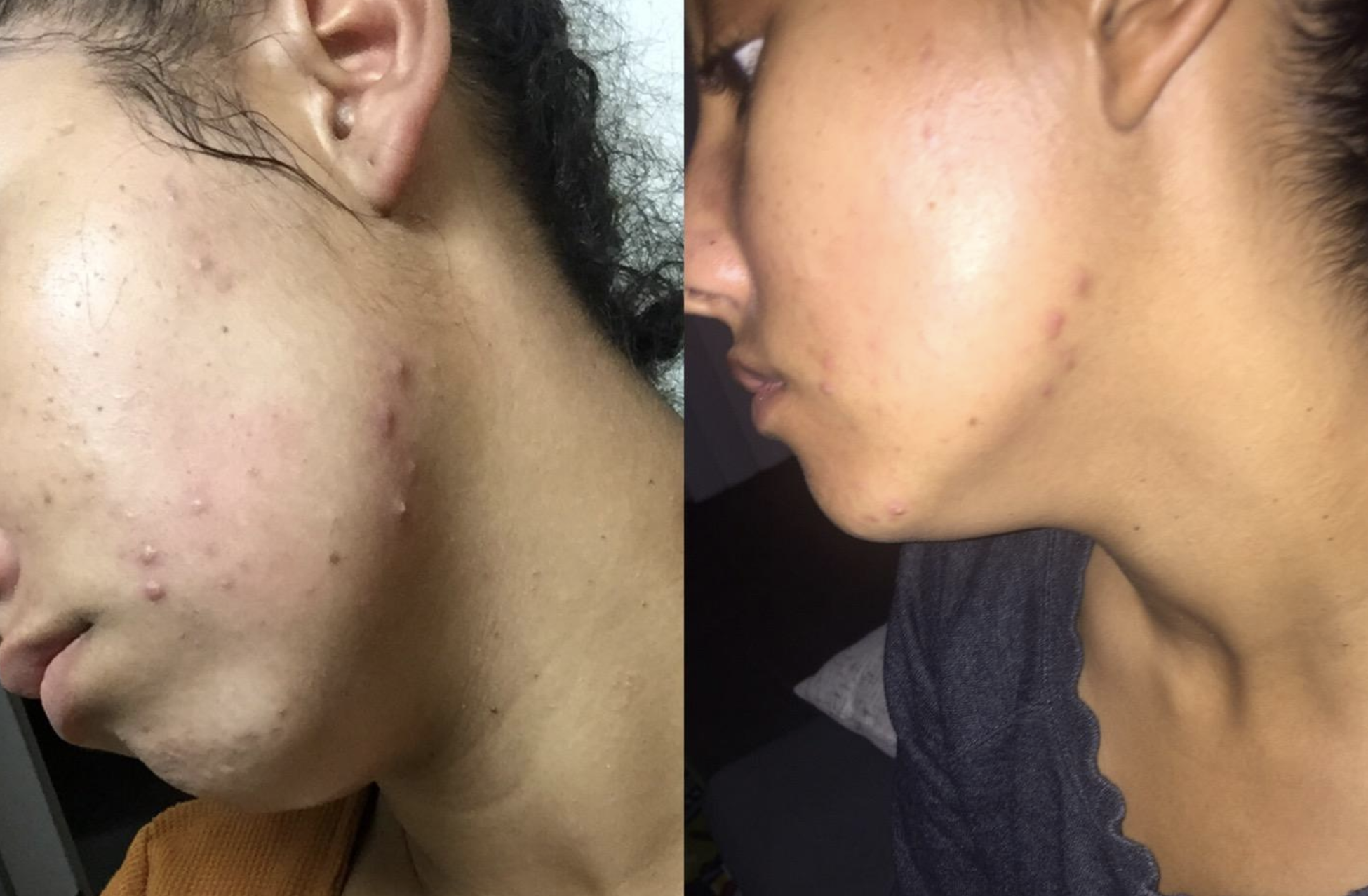 reviewer on left with visible acne on cheeks and on right, same reviewer with visibly less acne