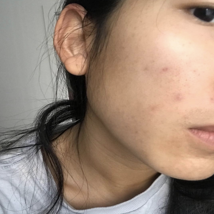 same person with significantly clearer skin 