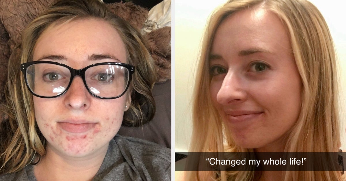 32 Things That Ll Help Get Rid Of Pimples As Fast As Possible 32 Things That Ll Help Get Rid Of Pimples As Fast As Possible