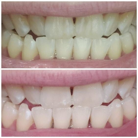 reviewer&#x27;s before and after of stained yellow teeth, then clean whiter teeth after use 