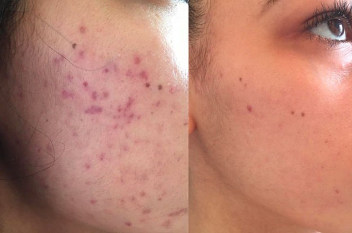 24 To Help You Deal With Acne Scars