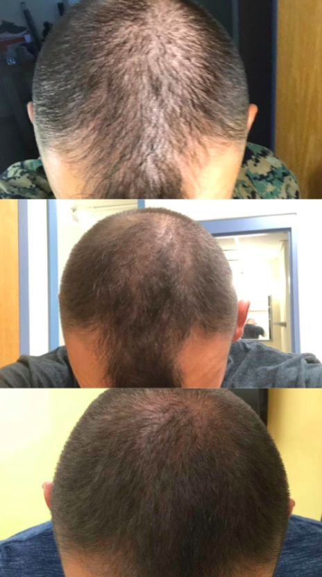 reviewer showing their hair before using the shampoo and then after, revealing they experienced some hair growth after consistent use 